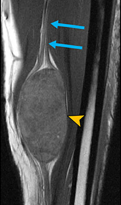 MR neurography imaging showing a tumor in ulnar-nerve.