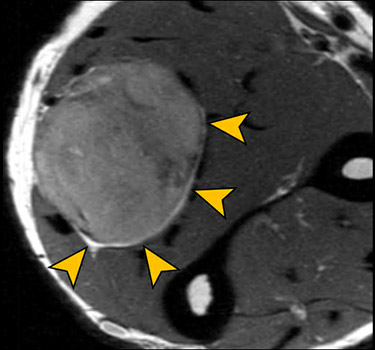 MR neurography imaging showing tumor in ulnar nerve.