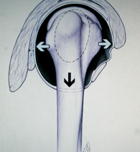 Diagram of multidirectional dislocation