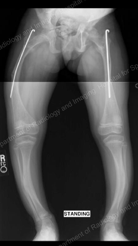 X-ray of a growing child with osteogenesis imperfecta treated with intramedullary rods