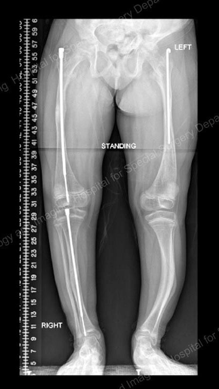 X-ray of a growing child with osteogenesis imperfecta with one intramedullary rod and one Fassier-Duval Rod.