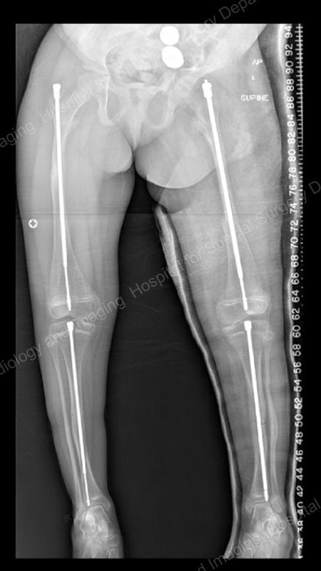 X-ray of a growing child with osteogenesis imperfecta treated with Fassier-Duval rods after outgrowing intramedullary rods.