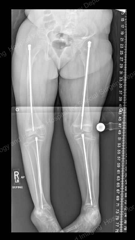 X-ray of a growing child with osteogenesis imperfecta who was treated with Fassier-Duval rods after outgrowing intramedullary rods.