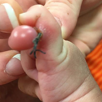 Polydactyly tied off and infected.