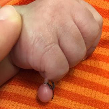 Polydactyly finger tied off, red and inflammed.