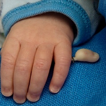 Polydactyly finger tied off to die. Not recommended.