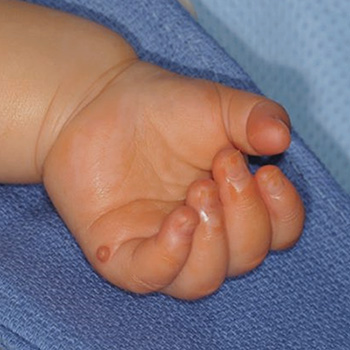 Tied off a postaxial polydactyly with painful residual bump.