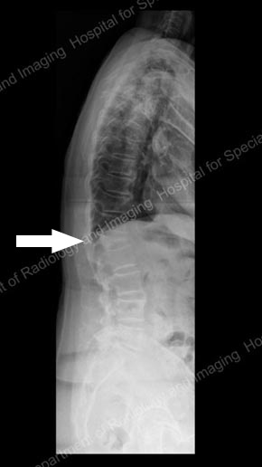 X-ray of a female patient with a compression fracture