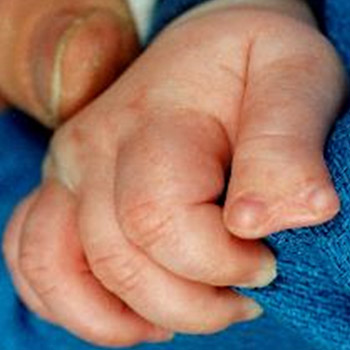 A preaxial polydactyly with two completely conjoined thumbs of slightly different sizes and facing away from one another..