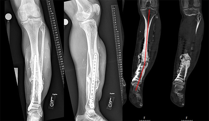X-rays before revision surgery showing nonunion, deformity and cellular death of bone tissue
