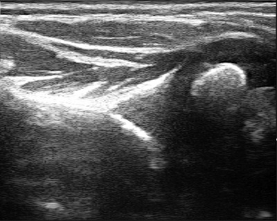 Ultrasound image of shoulder with severe glenohumeral dysplasia.