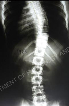 Scoliosis X-ray.