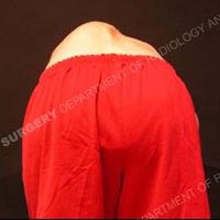 A man with scoliosis bending over.