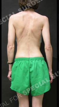 A man with scoliosis.