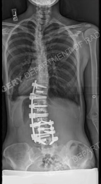A scoliosis X-ray.