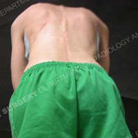 A man with scoliosis bending over.