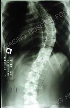 Scoliosis X-ray.