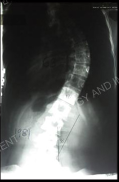 Scoliosis X-ray.