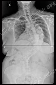 Scoliosis X-ray.