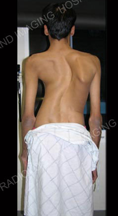 A man with scoliosis.