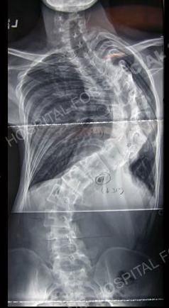 Scoliosis X-ray.