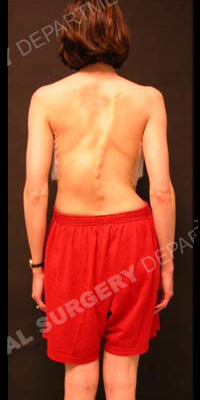 A man with scoliosis.