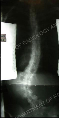 A scoliosis X-ray.