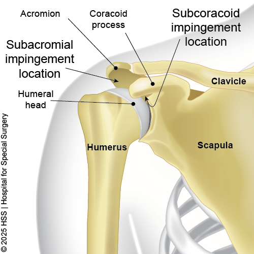 Bones of the shoulder showing impingement locations.
