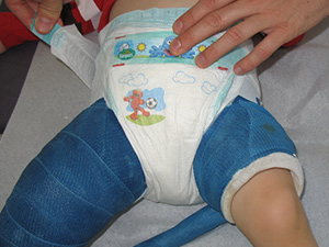Wrapping a large diaper outside cast.