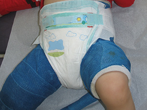 Large diaper wrapped outside cast.