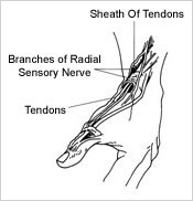 Illustration of de Quervain tenosynovitis