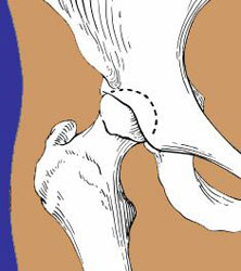 Illustration of hip joint