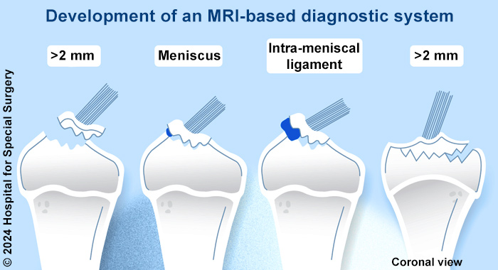 Illustration of variables in tibial spine fractures measured using a new MRI-based diagnostic system.