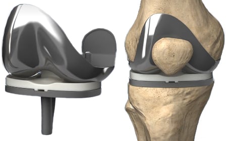 Illustration of a fixed-bearing knee prosthesis