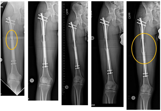 X-ray of an osteotomy of the femur and limb lengthening using percutaneous approach, with a three-month progression to 8 cm (3.25 inches).