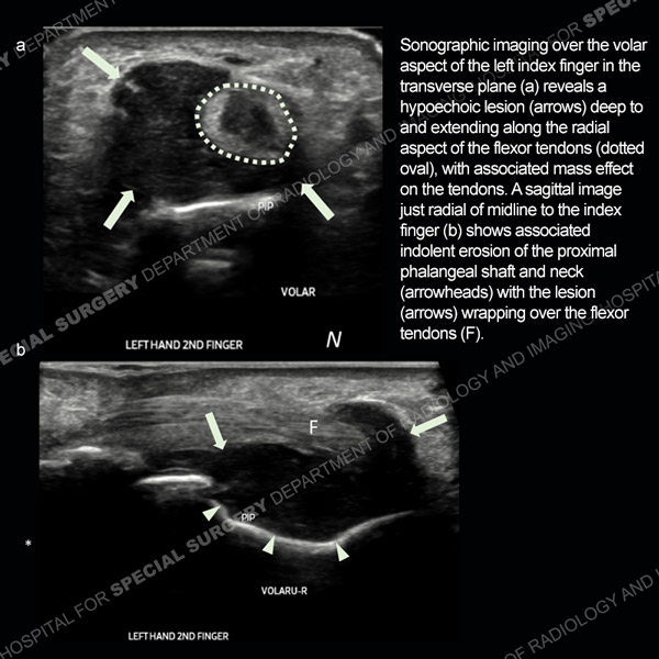 Two stacked sonographic images of left index finger - Ultrasound Case 186