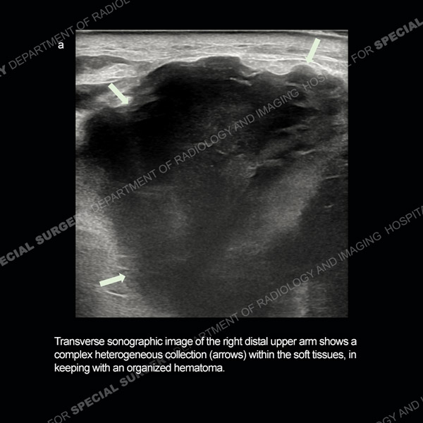 Transverse sonographic image of the right distal upper arm 