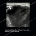 Ultrasound thumbnail image of case 189 - sonographic image of the right distal upper arm