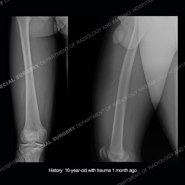 Radiograph image of right femoral bone for Case 218