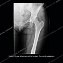 Radiograph of left hip Case 222