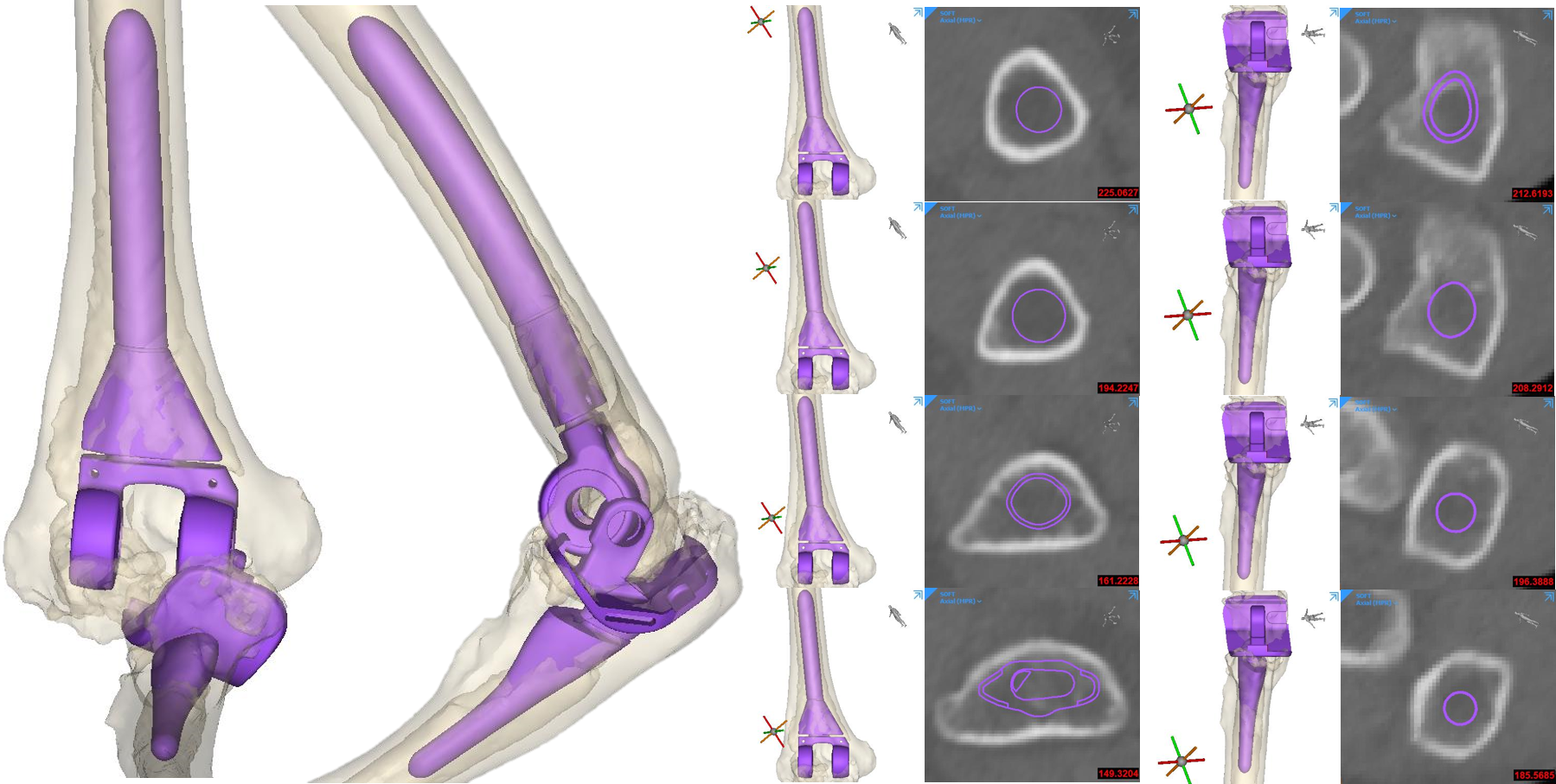 Initial fit check of standard TEA component was done by the device development engineers. Both humeral and ulnar components were too small for a cementless TEA.  Patient specific implants were needed.