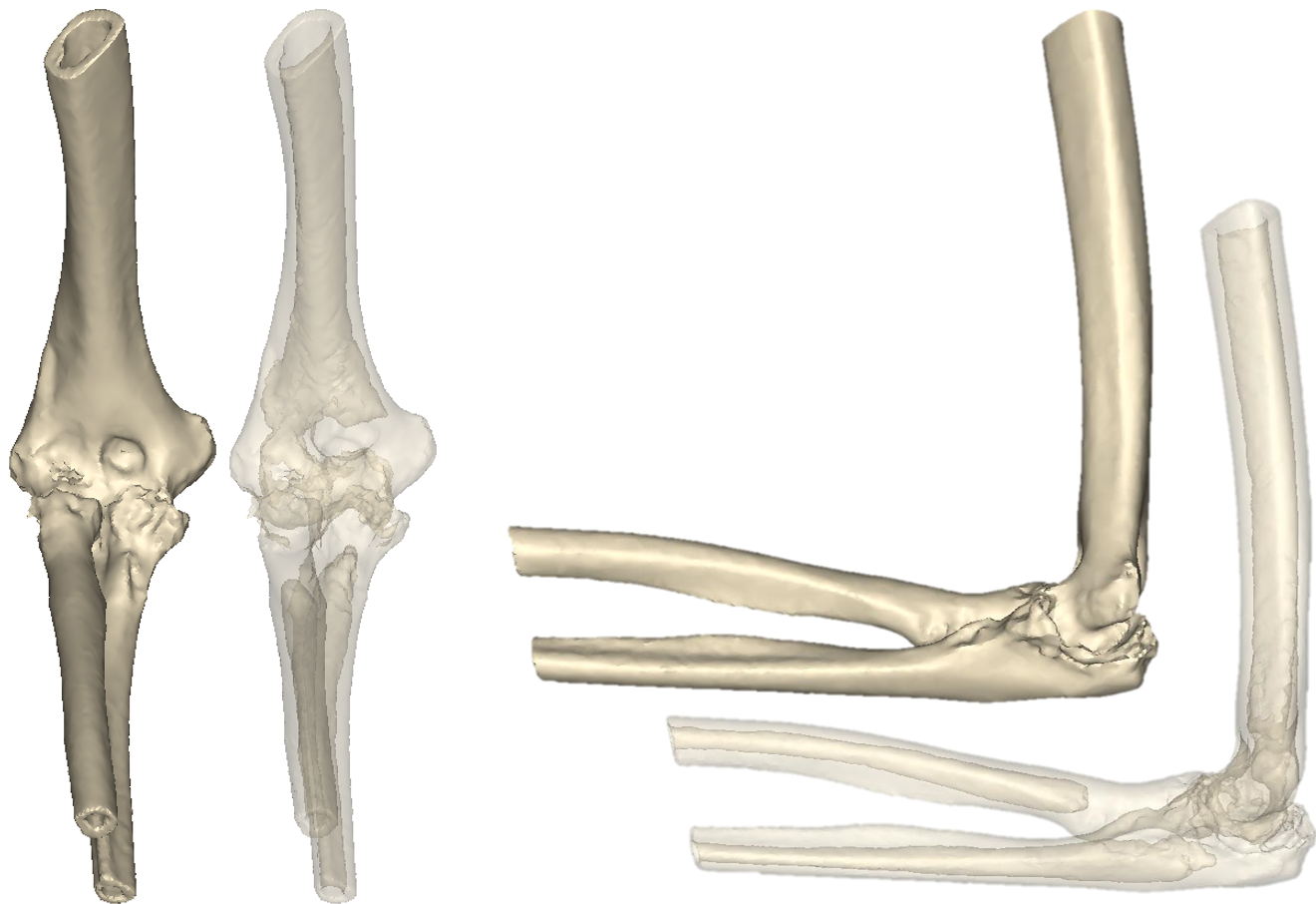 X-rays showing a right elbow of a patient with rheumatoid arthritis. Surgeon would like to perform cementless total elbow arthroplasty (TEA) on the patient.
