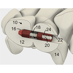 Interosseous Coupler