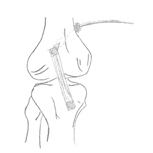 OrthoKnot Suture