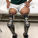 Osseointegration Limb Replacement Center