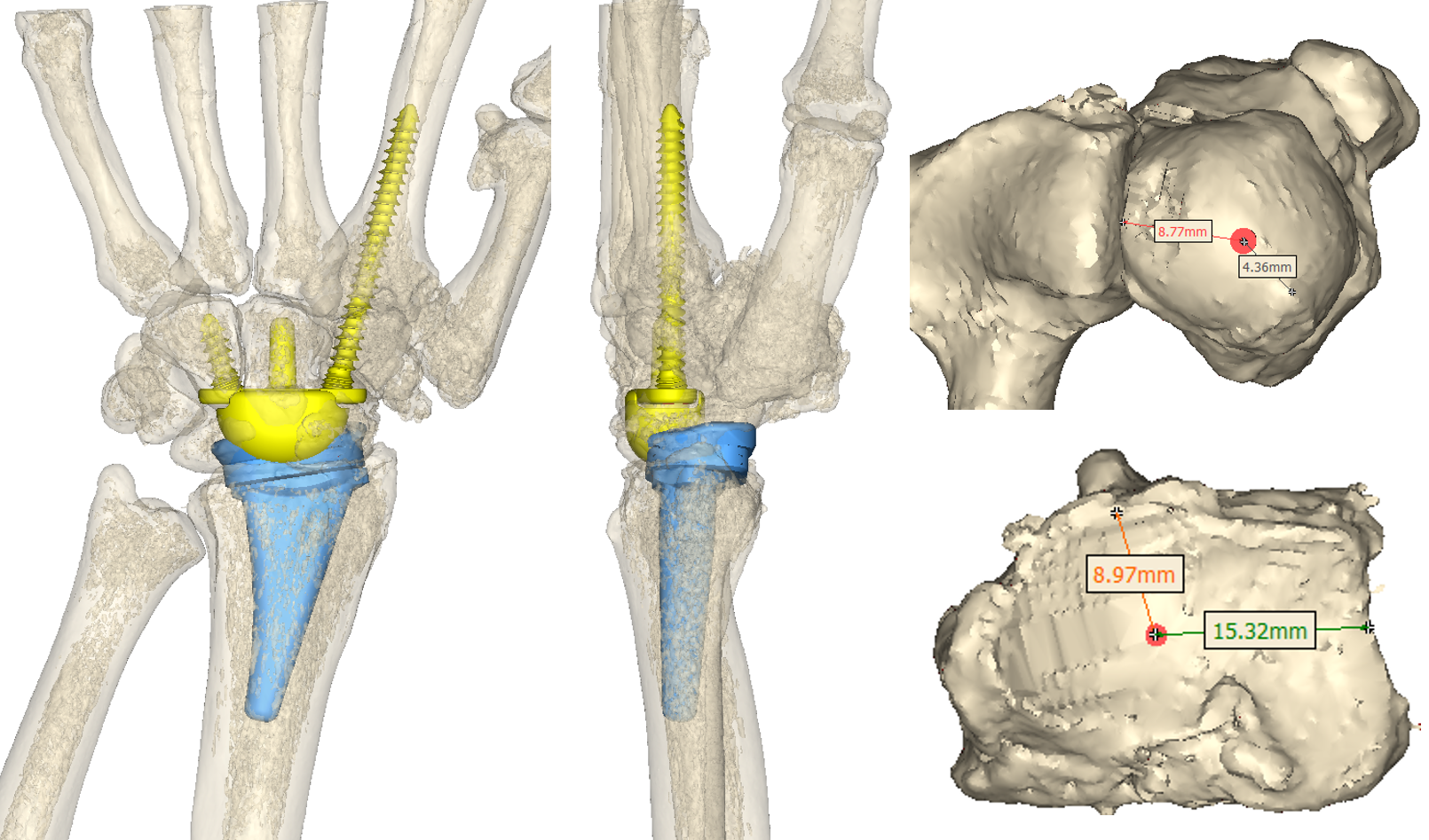 Measurements are provided to the surgeon to assist with accurate placement of guide wires during the surgical procedure.
