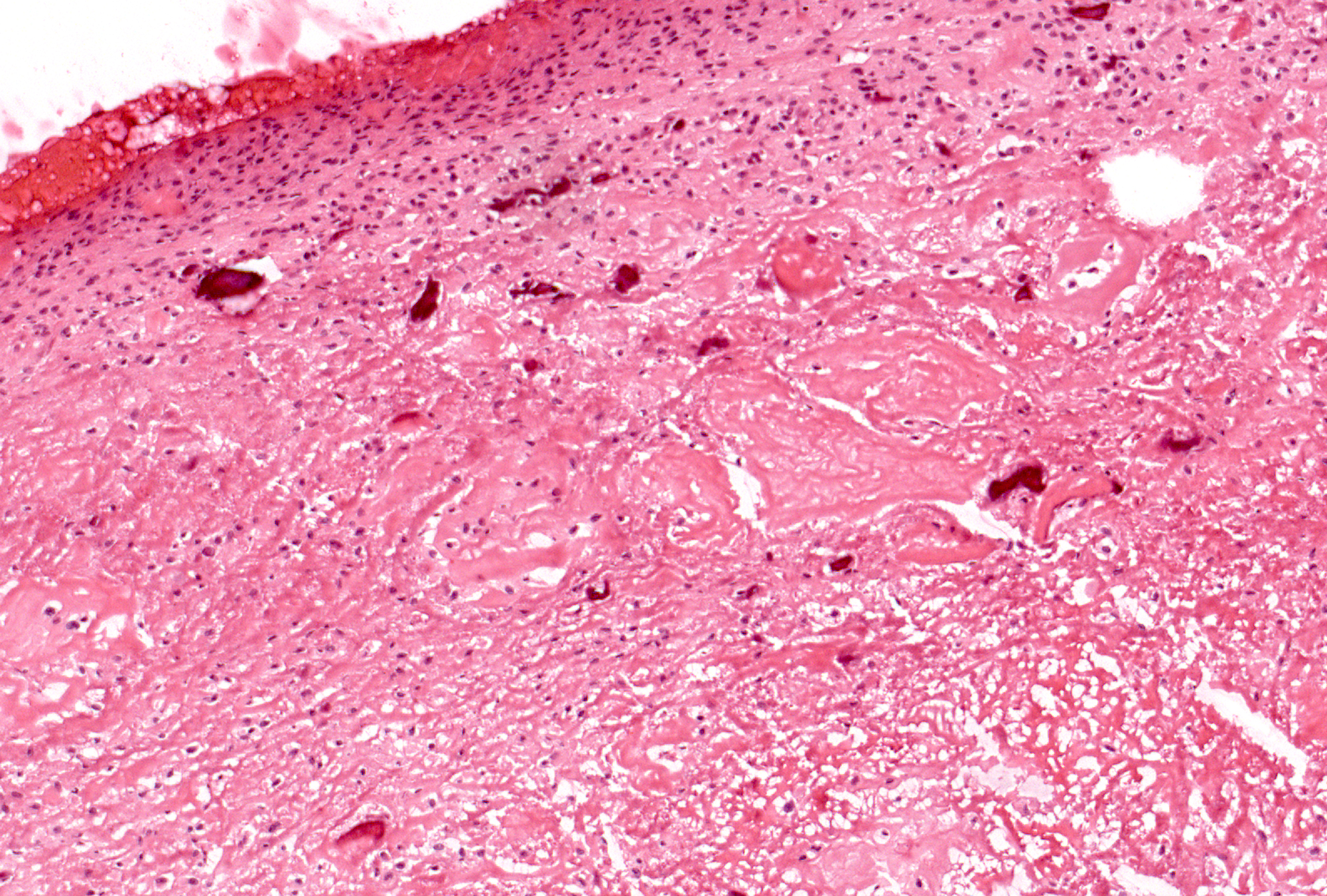 These small irregular particles of granular material represent debris generated within the joint and originate from bone (shown) and sometimes also articular cartilage (not shown).