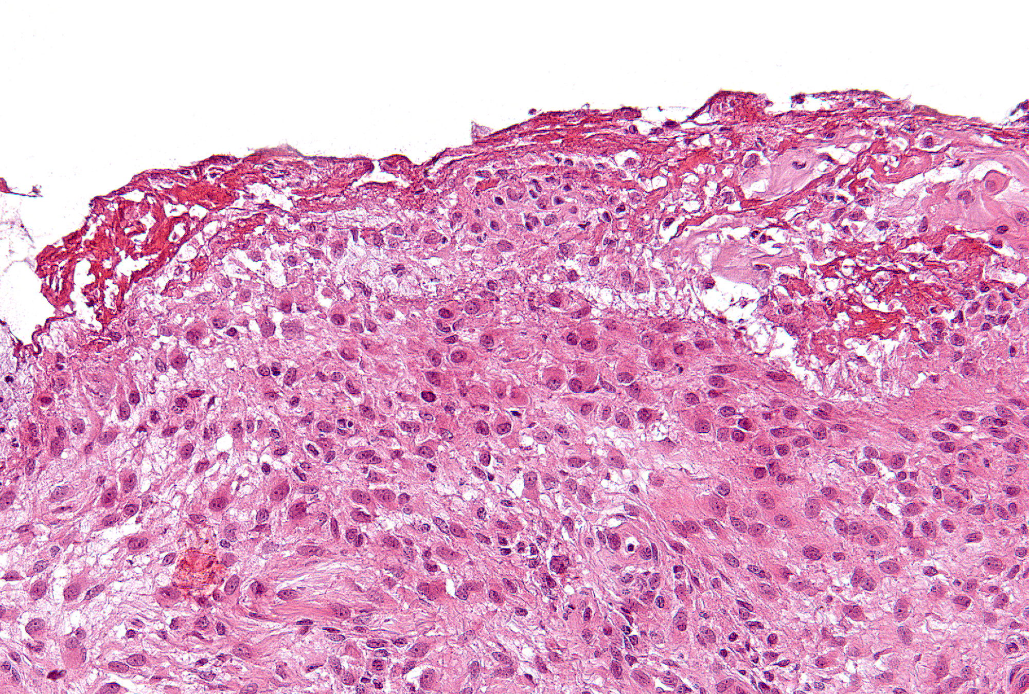 Grade 1 (present), Slight: A thin layer of granular dark pink fibrin is present at the surface (top) of this synovium overlying a thickened synovial lining layer.