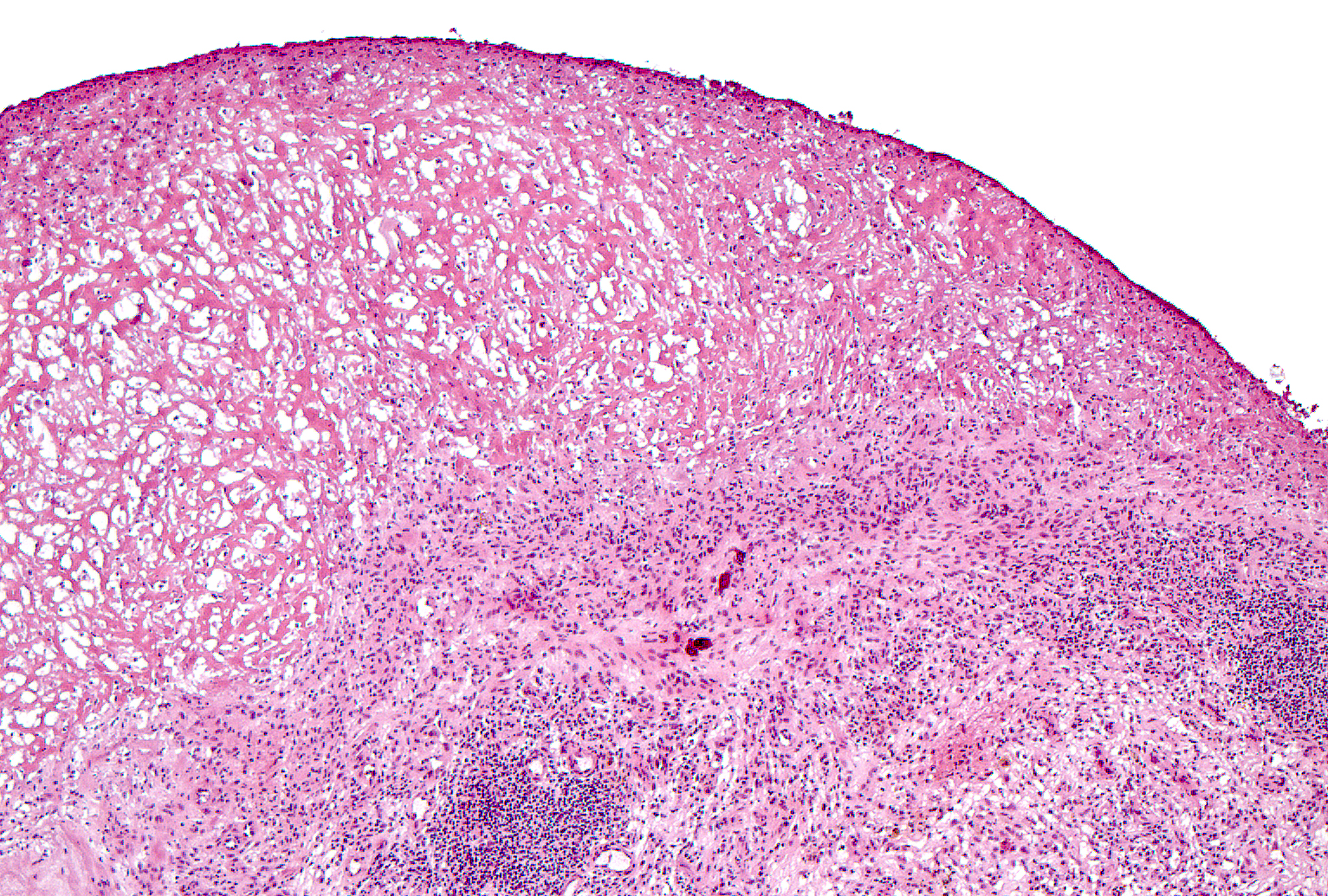 Grade 1 (present), Marked: A thick layer of fibrin overlies the synovial lining, which is thickened but has blurred edges. Grade 2 inflammation is present in the subjacent synovial tissue.