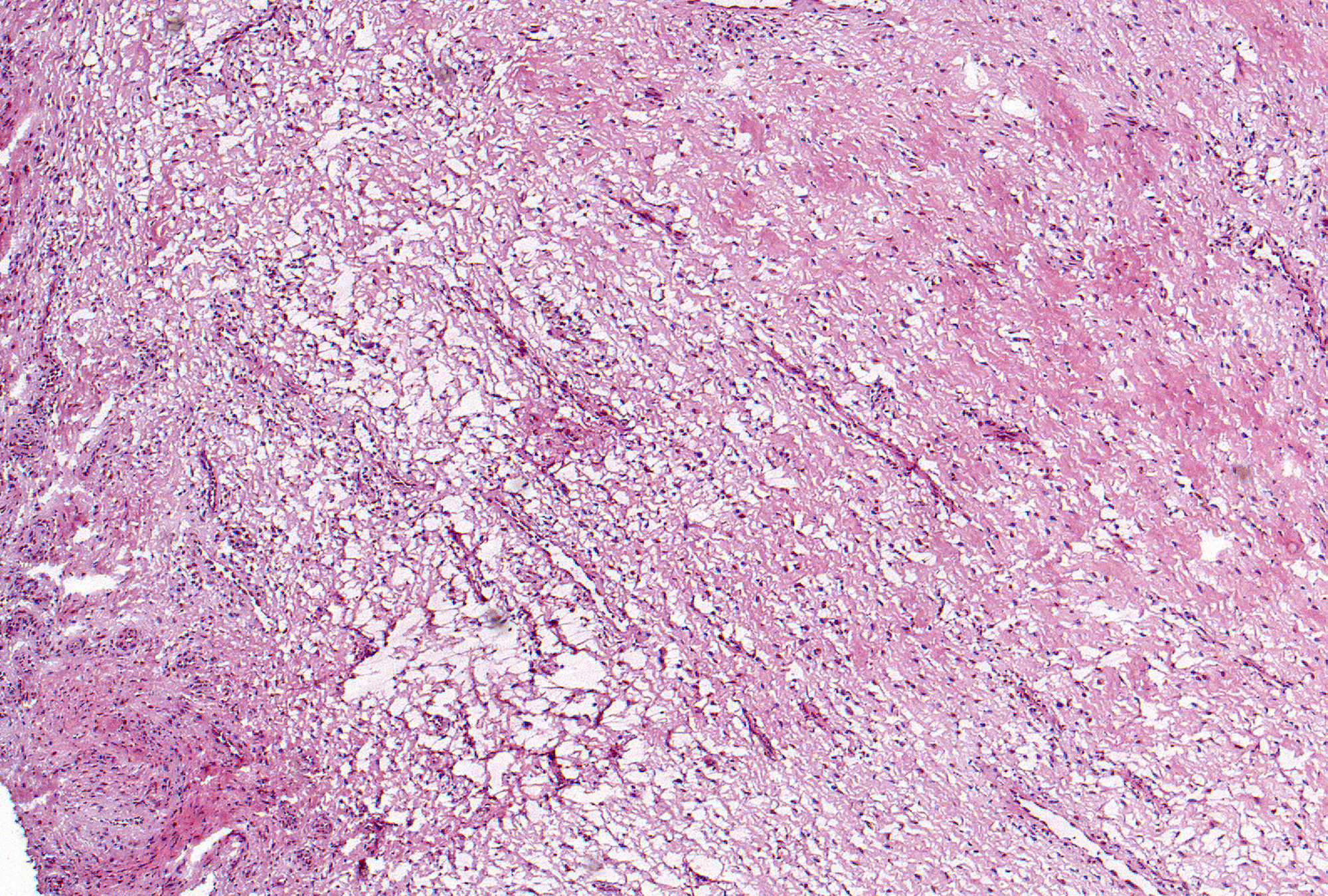 Fibrosis appears as pink, fibrillary, collagenous material results in the focal, widespread, and band-like displacement of the synovial fat resulting in with obliteration of the overall architecture of the synovium.